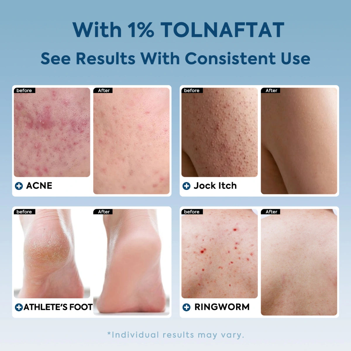 qualiLife-tea-tree-antifungal_soap_before_after_display
