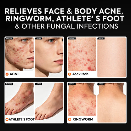 qualilife_charcoal_antifungal_soap_before_after_display