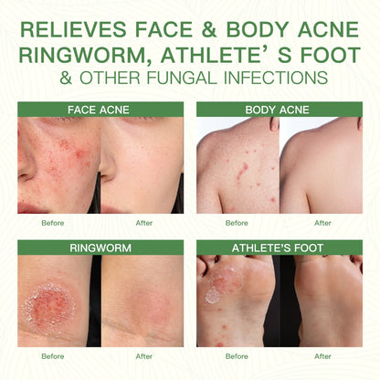 qualilife_tea_tree_soap_before_after_display